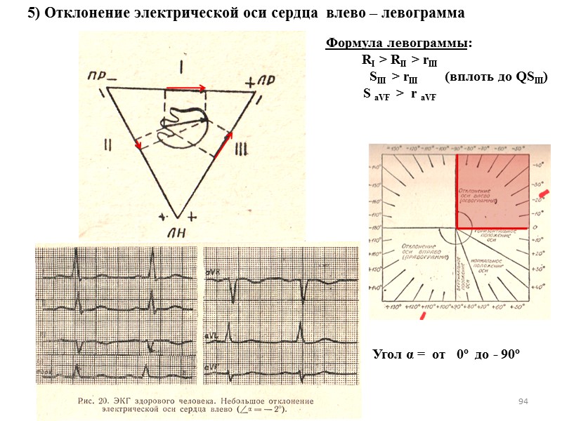 94 5) Отклонение электрической оси сердца  влево – левограмма Формула левограммы: RI >